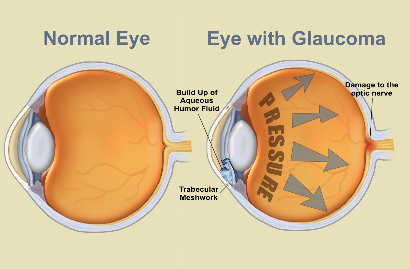 Glaucoma Schemtic